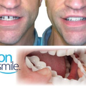 Carillas snap on smile dientes